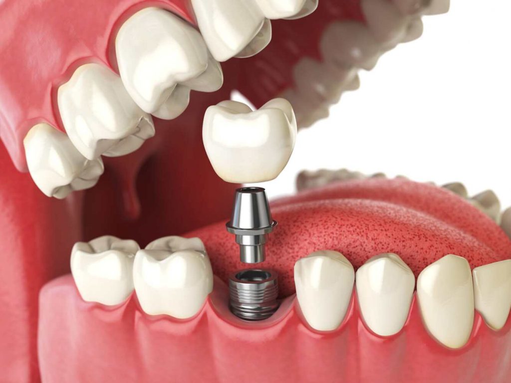 Importance of Dental Implants in Modern Dentistry - Aspire Dental