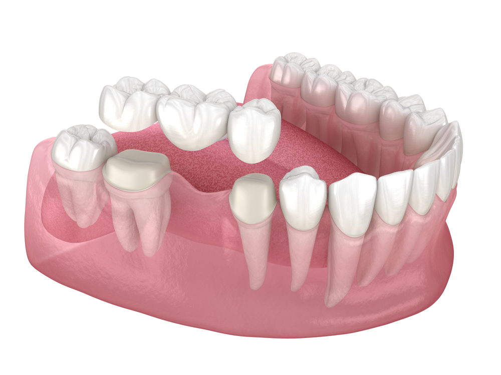 advances in dental bridge technology: what’s new?